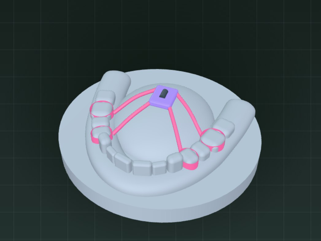 Finished palatal expander with bands and screw on an upper model