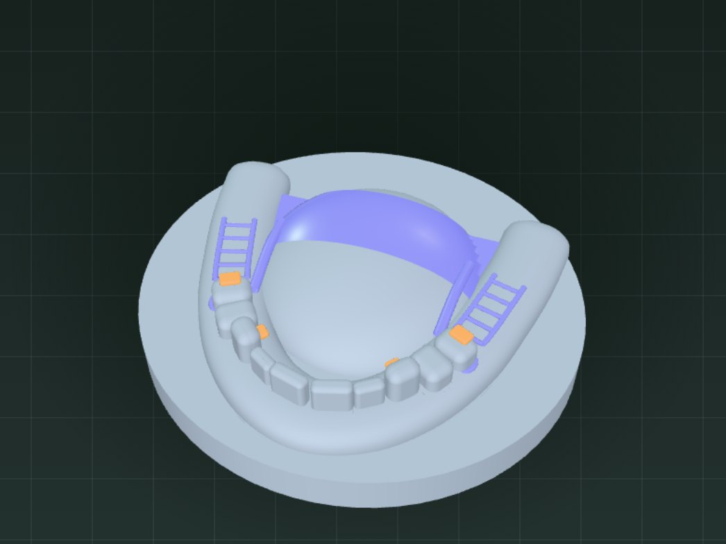 Finished partial denture framework on an upper model